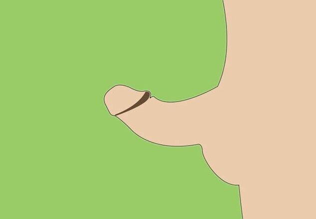 انحنای آلت تناسلی به عنوان نشانه ای برای بزرگ شدن جراحی